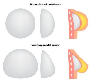 Breast prosthesis in Iran